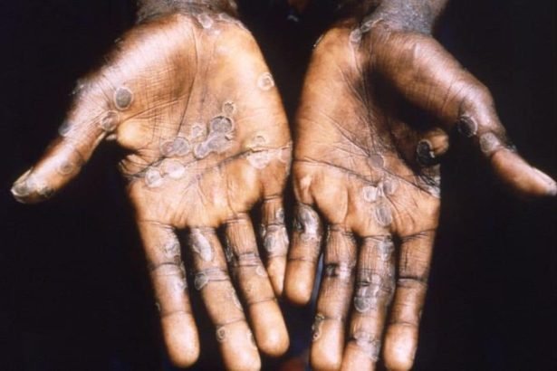 Mpox Keeps Coming Back and Scientists Are Starting to Understand Why